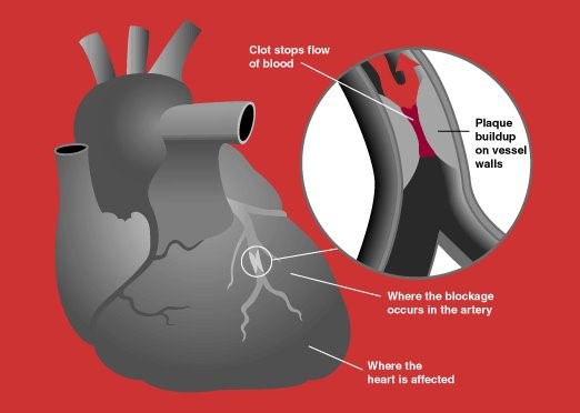 Predicting Heart Attack Risk